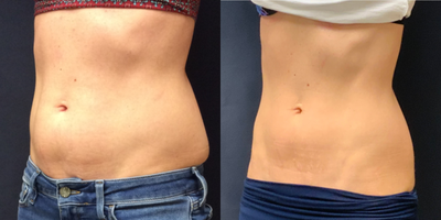 SculpSure before and after photo