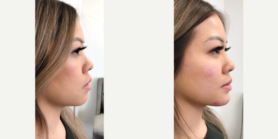 Chin Filler before and after photo