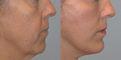 Chin Implant before and after photo