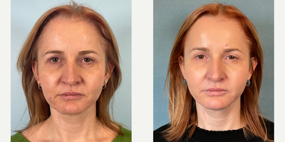 before and after image