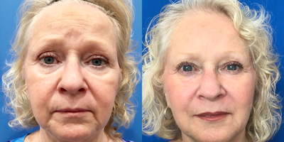 Liquid Facelift before and after photo