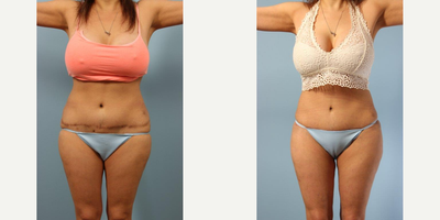 Renuvion before and after photo