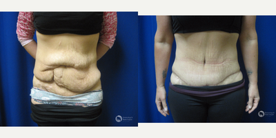Tummy Tuck before and after photo