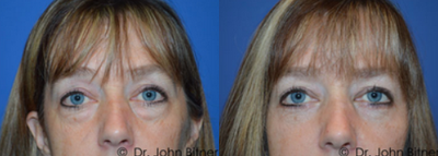 Eyelid Surgery before and after photo