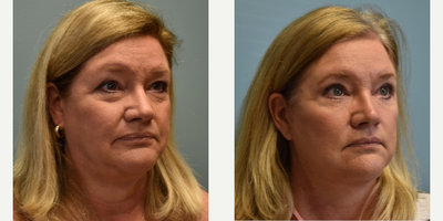 Eyelid Surgery before and after photo