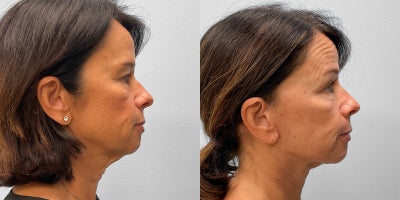 Facelift before and after photo