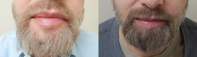 Hair Transplant before and after photo