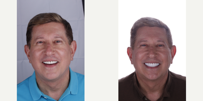 Teeth Whitening before and after photo