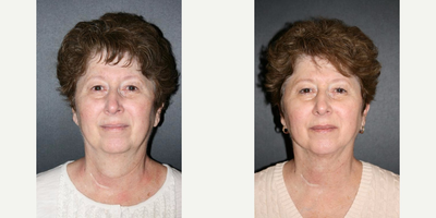 Chin Liposuction before and after photo