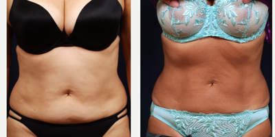 CoolSculpting before and after photo