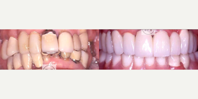 Dental Crown before and after photo