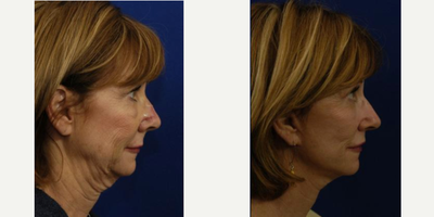 Facelift before and after photo