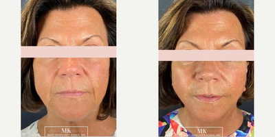 Facial Fat Transfer before and after photo