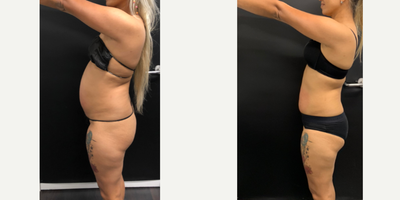 vShape before and after photo