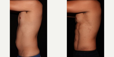 Abdominal Etching before and after photo