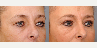 Eyelid Surgery before and after photo