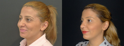 Rhinoplasty before and after photo