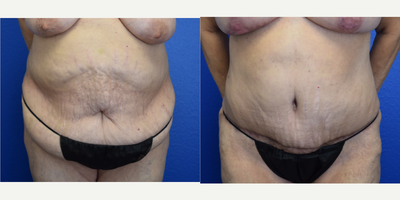 Tummy Tuck before and after photo