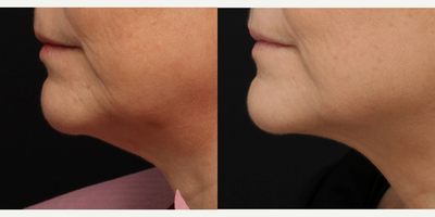 Cheek Lift before and after photo