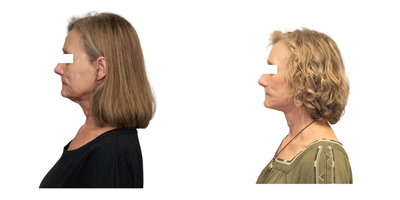 Facelift before and after photo