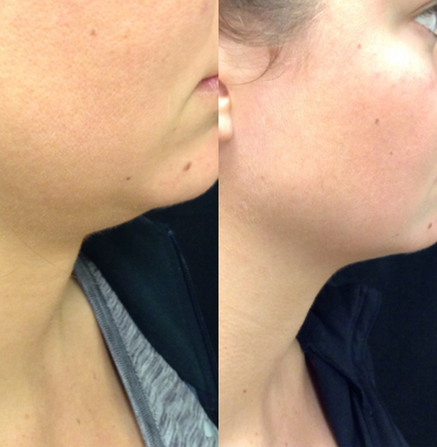 Kybella before and after photo