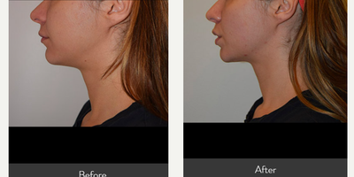 Morpheus8 before and after photo