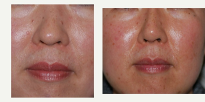 Asian Rhinoplasty before and after photo