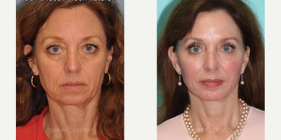 Nonsurgical Facelift before and after photo