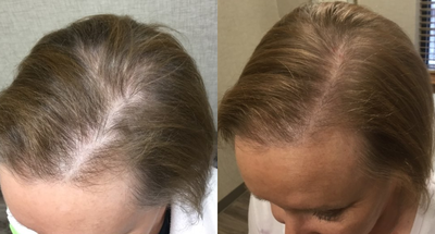 PRP for Hair Loss before and after photo
