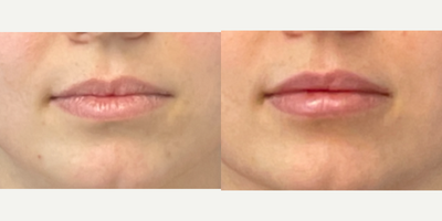Dermal Fillers before and after photo