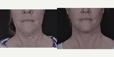 Facelift before and after photo