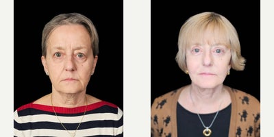 Facelift before and after photo
