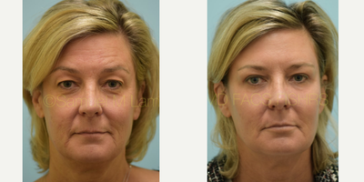Facial Fat Transfer before and after photo