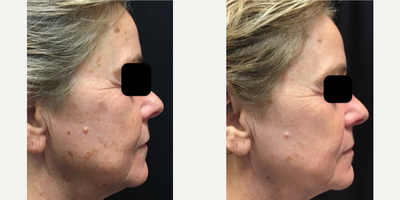 IPL before and after photo