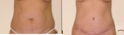 Tummy Tuck before and after photo