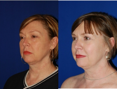 Eyelid Surgery before and after photo