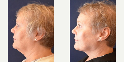 Facelift before and after photo