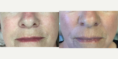 Microneedling before and after photo