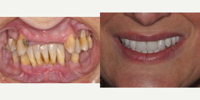 All-on-4 Dental Implants before and after photo