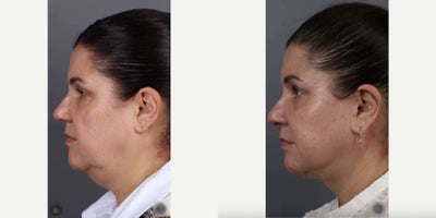 Facial Fat Transfer before and after photo