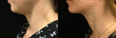 Kybella before and after photo