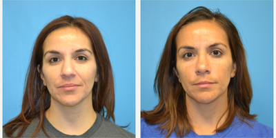 Rhinoplasty before and after photo