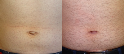 Belly Button Surgery before and after photo