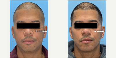 Chin Implant before and after photo