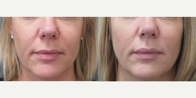 Dermal Fillers before and after photo