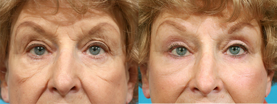 Eyelid Surgery before and after photo