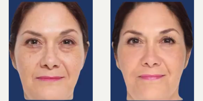 Fraxel Laser before and after photo