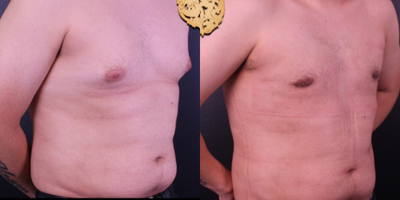 Gynecomastia Surgery before and after photo