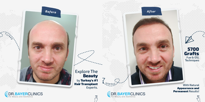 Hair Transplant before and after photo