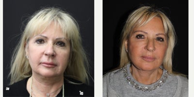 Neck Lift before and after photo